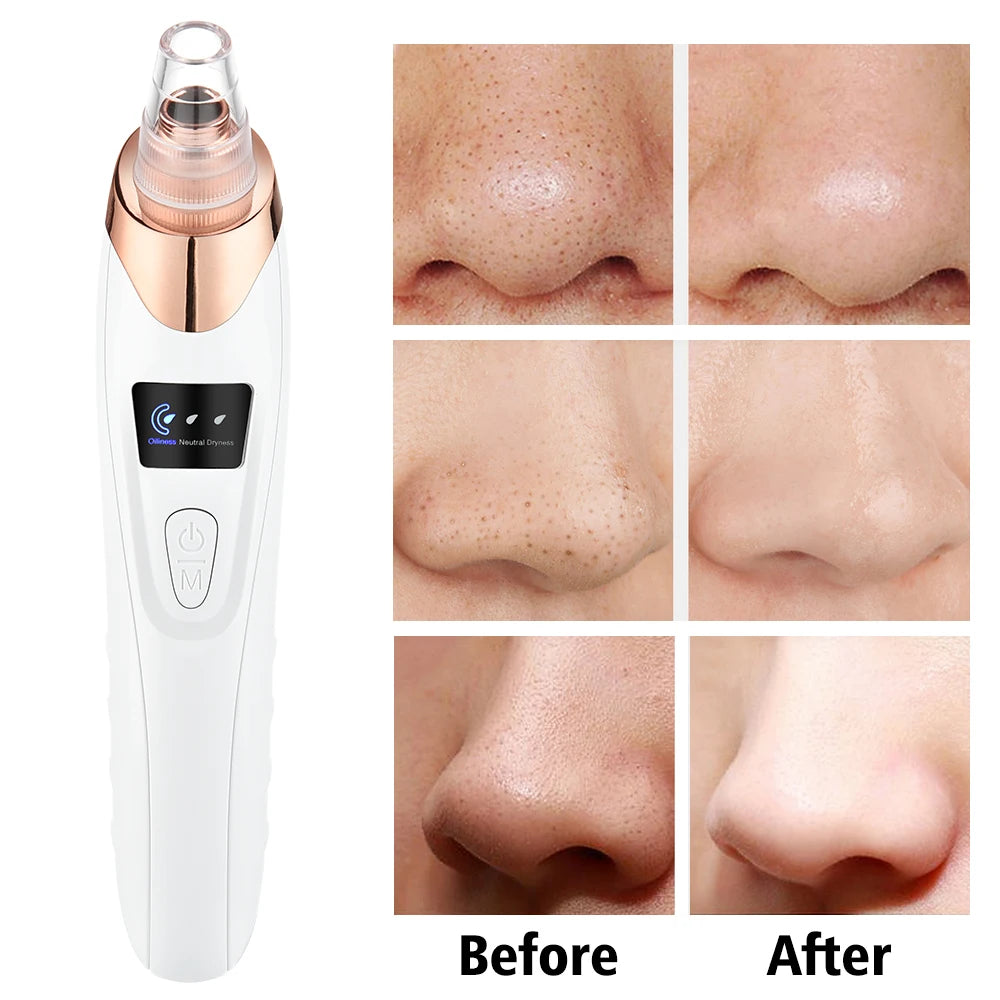 🌟 Professionele Elektrische Blackhead Remover – Voor een Schone & Stralende Huid! 💆‍♀️✨