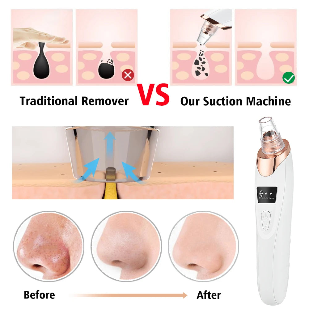 🌟 Professionele Elektrische Blackhead Remover – Voor een Schone & Stralende Huid! 💆‍♀️✨